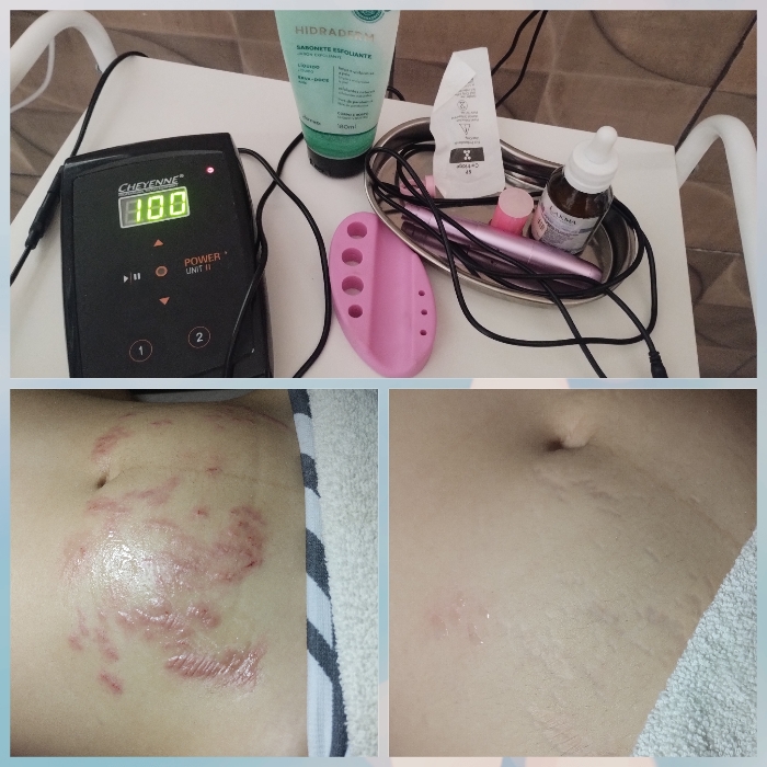 método microderme tratamento de estrias