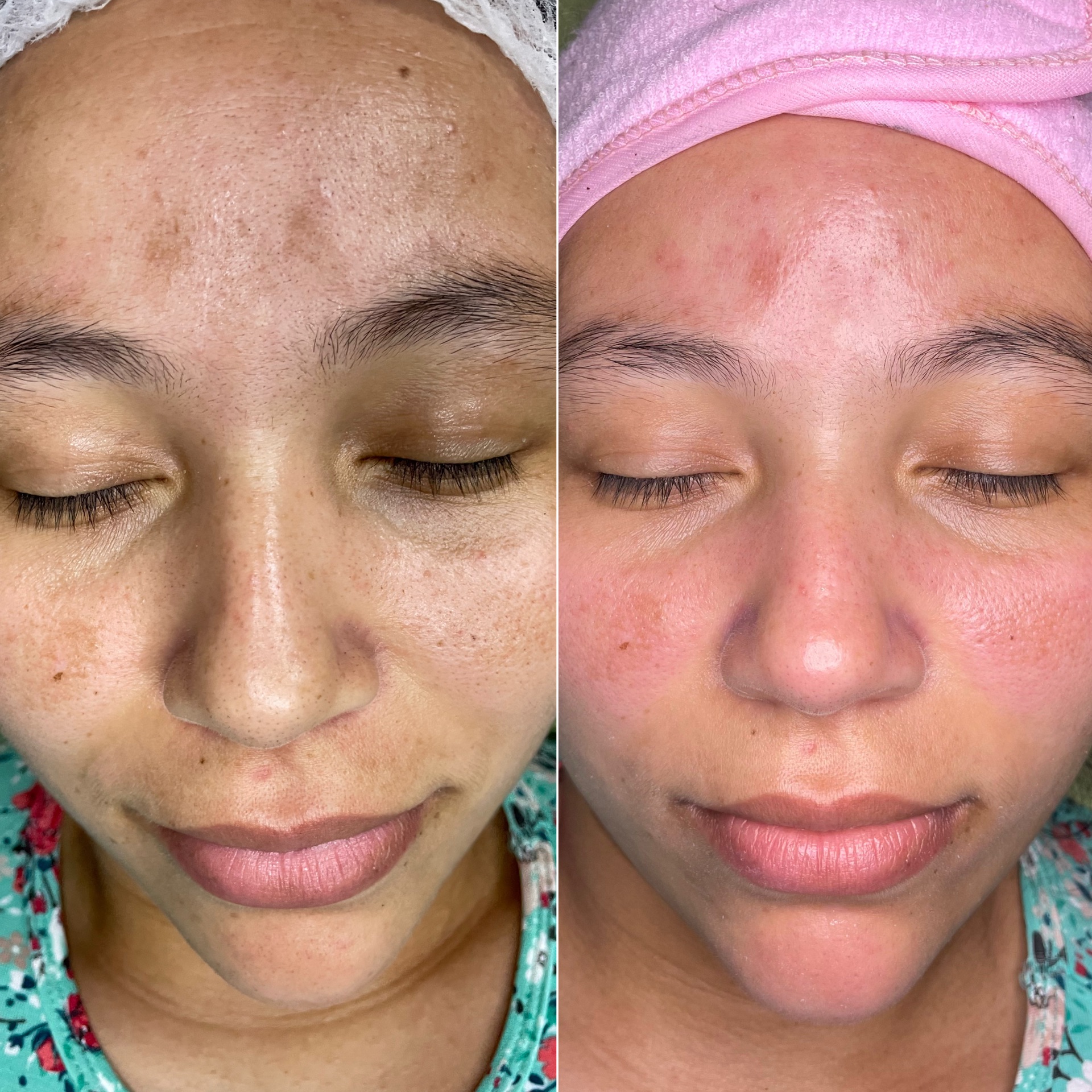 Combo Melasma