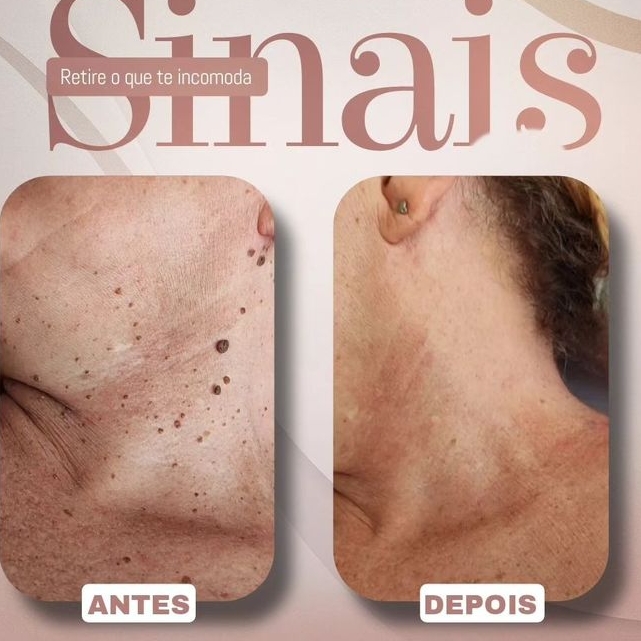 Remoção de Verrugas e sinais