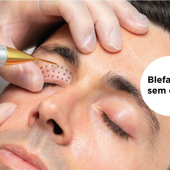 Blefaroplastia sem corte 1 sessão