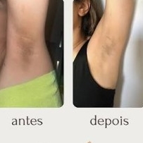depilação a laser axila