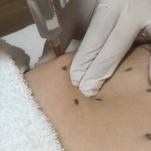 Hidrolipoclasia não aspirativa