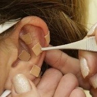 Auriculoterapia