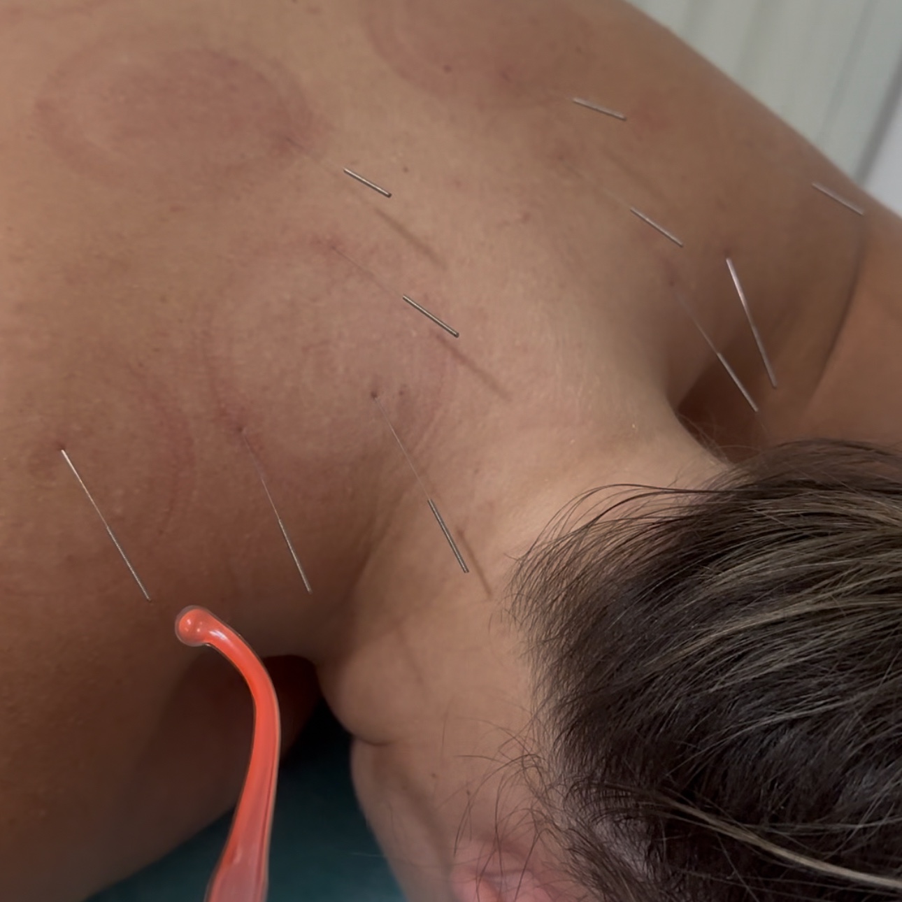 Dry Needling Com Alta Frequência