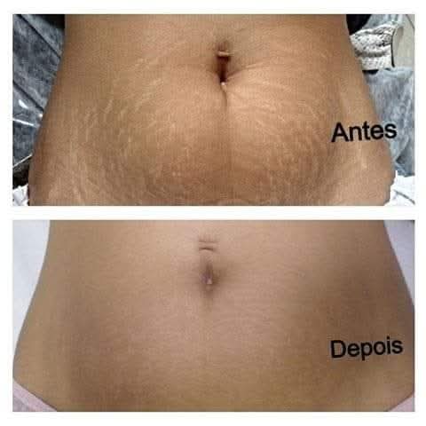 Tratamento de Estrias sessão