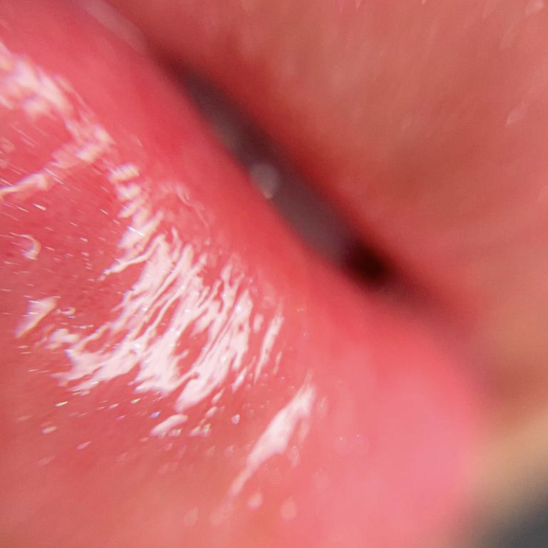 HIDRAGLOSS: Biorevitalização Labial