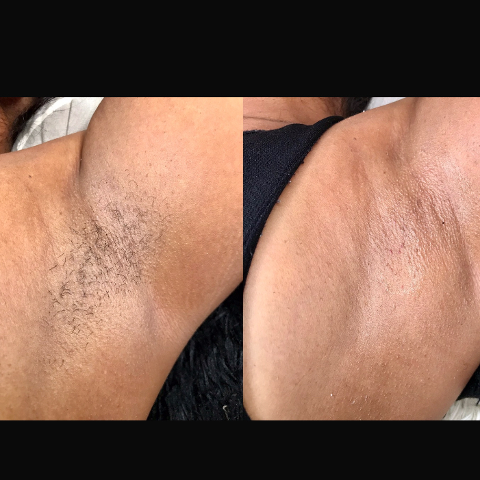 epilação nas axilas