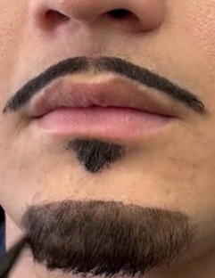 Pigmentação no Bigode ou Cavanhaque