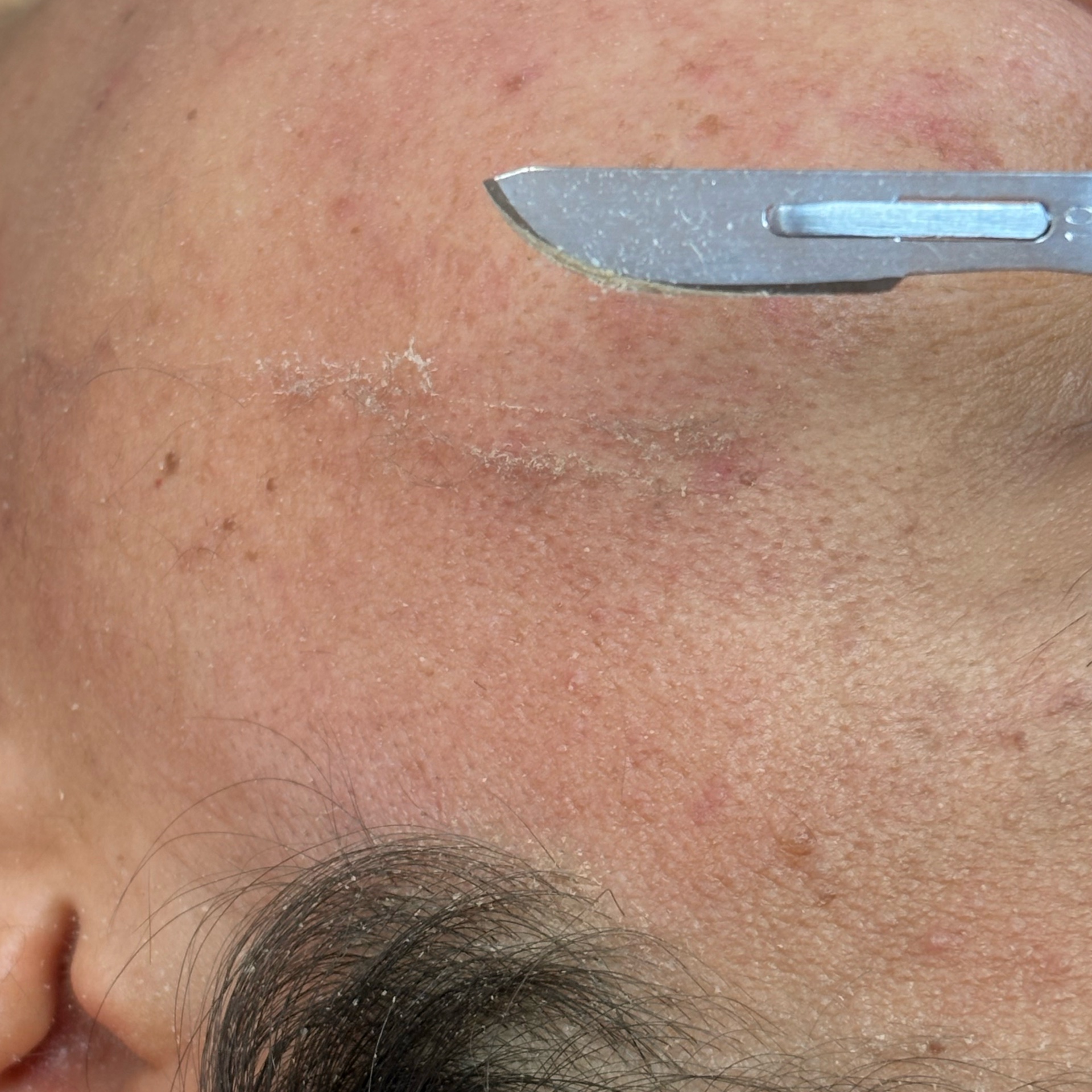 Dermaplaning