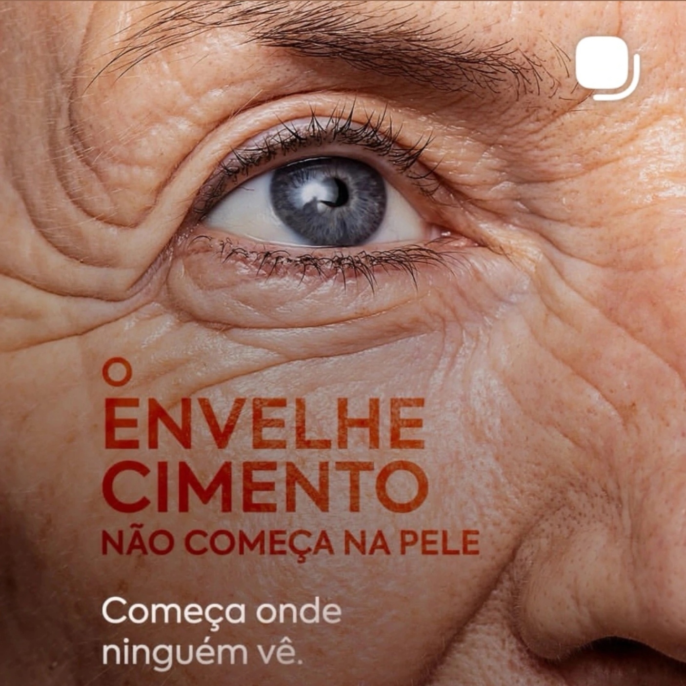 Bioestimuladores para Flácidez (Radiesse e Sculptra)