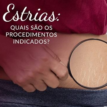 Tratamentos de Estrias