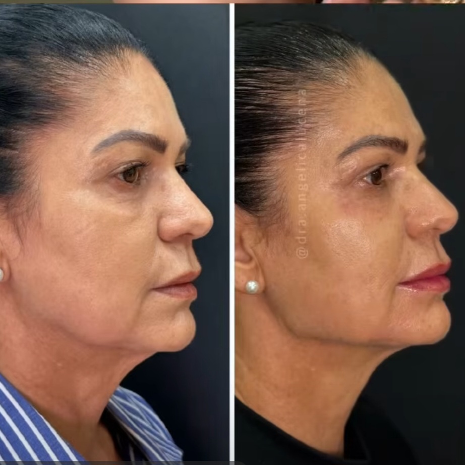 Preenchimento Facial 1ml