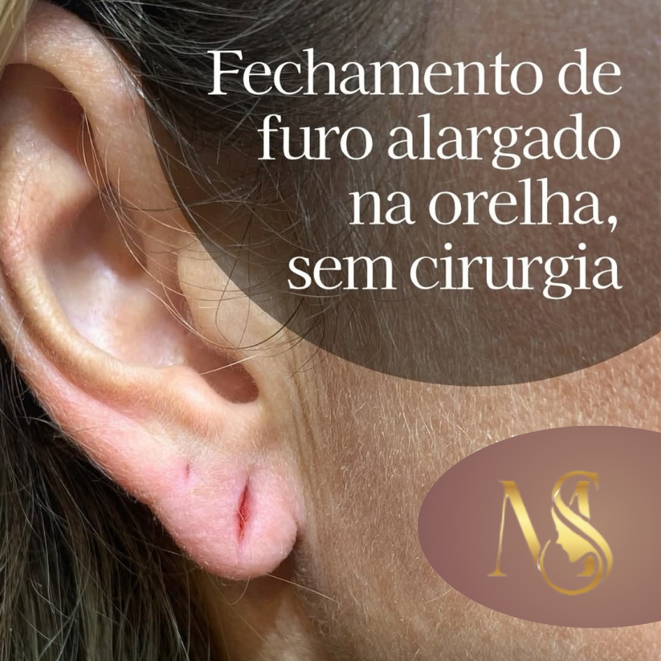 Lobuloplastia/ com ATA