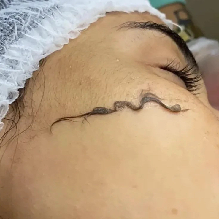 Dermaplaning Pefect