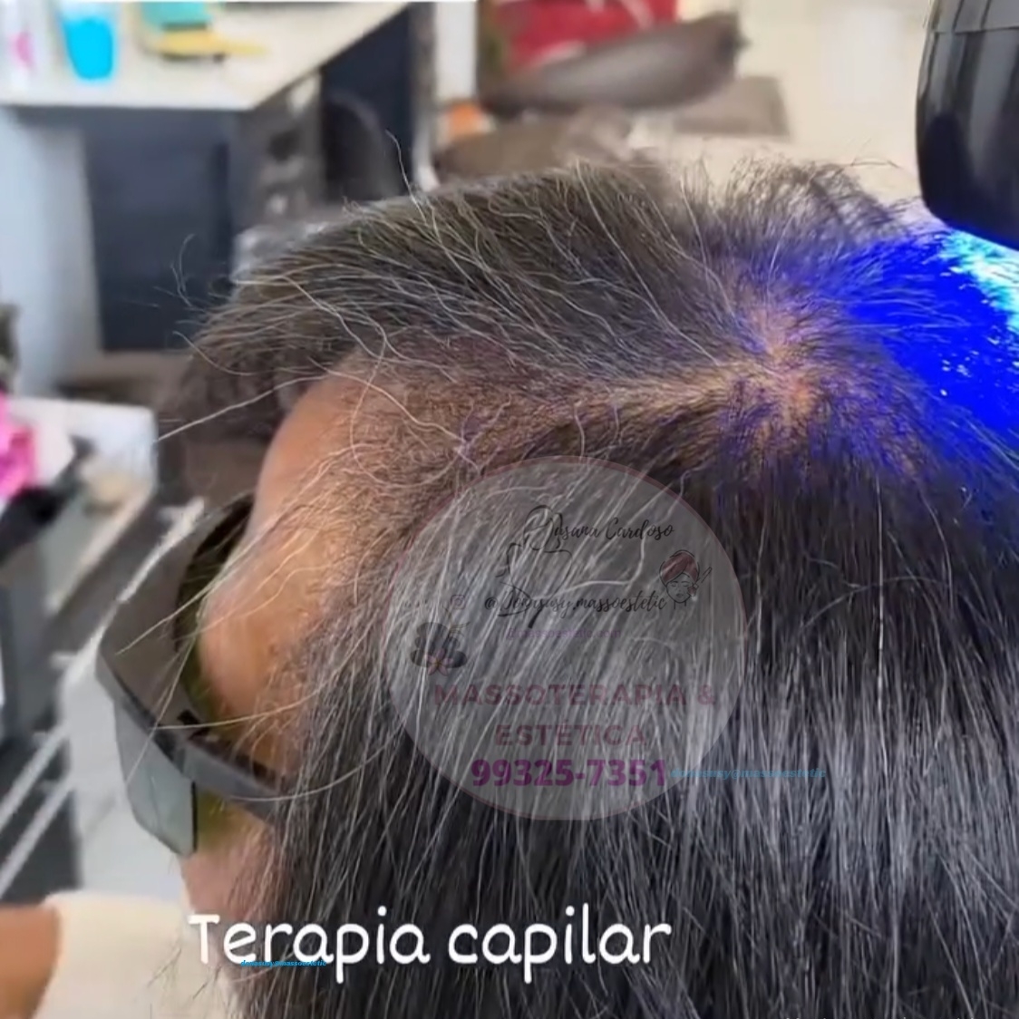 Microagulhamento facial, corporal ou capilar