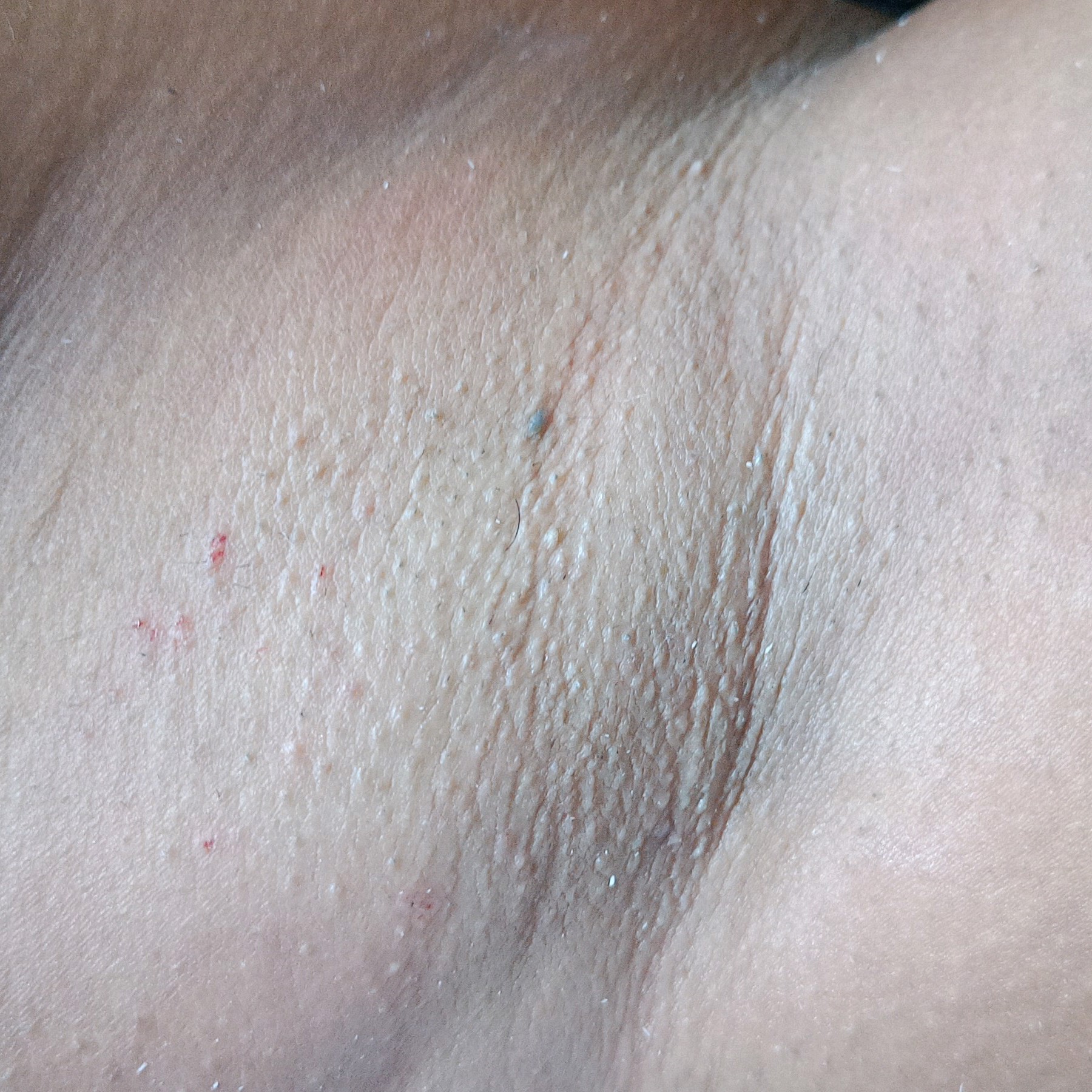 axila