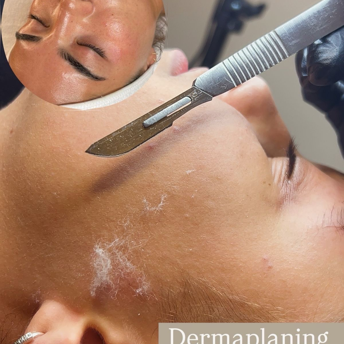 Limpeza de pele + Dermaplaning