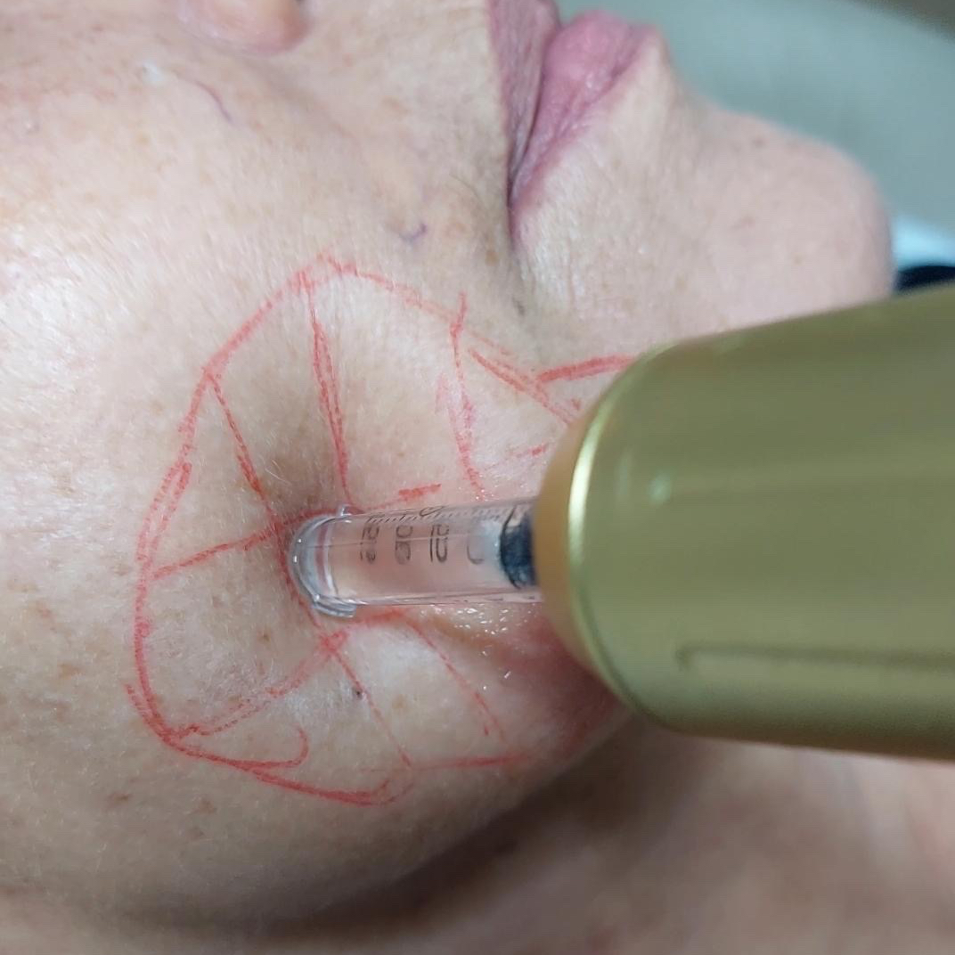 HyaluroPen Flacidez Tratamento - facial ou corporal 3 sessões