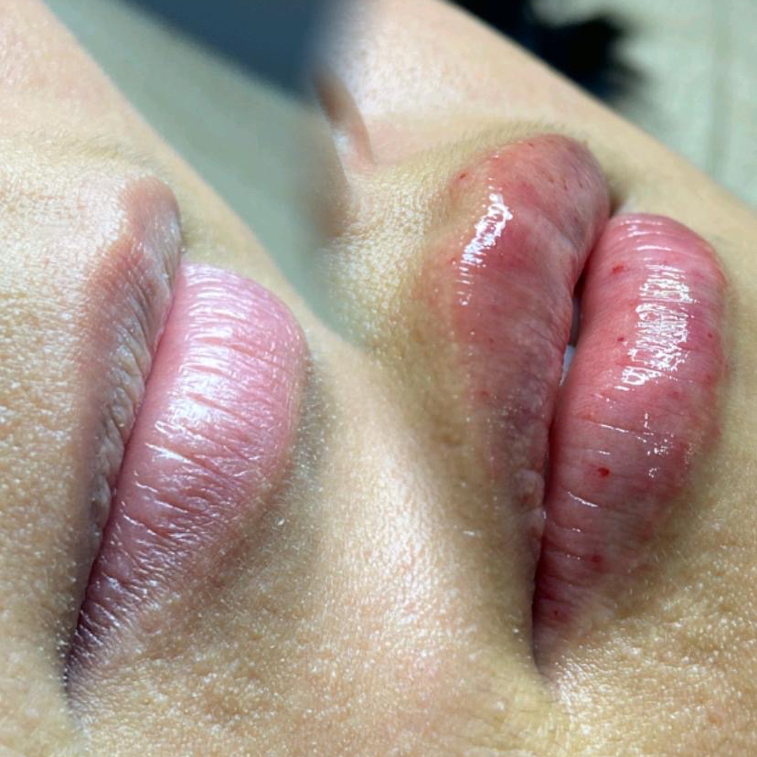 Hyaluropen Fluffy Lips - Skinbooster Labial - a sessão.