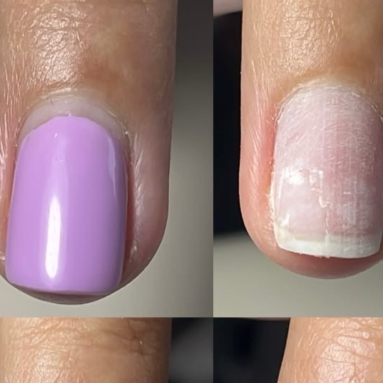 remoção de esmalte permanente