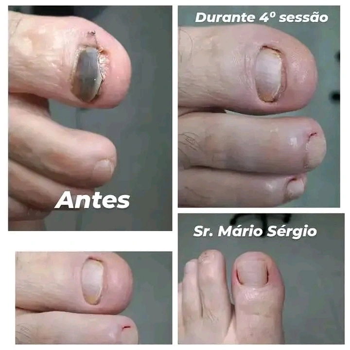 Laserterapia tratamento