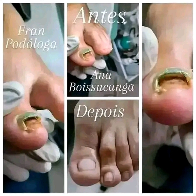Pacote de tratamento Onicomicose