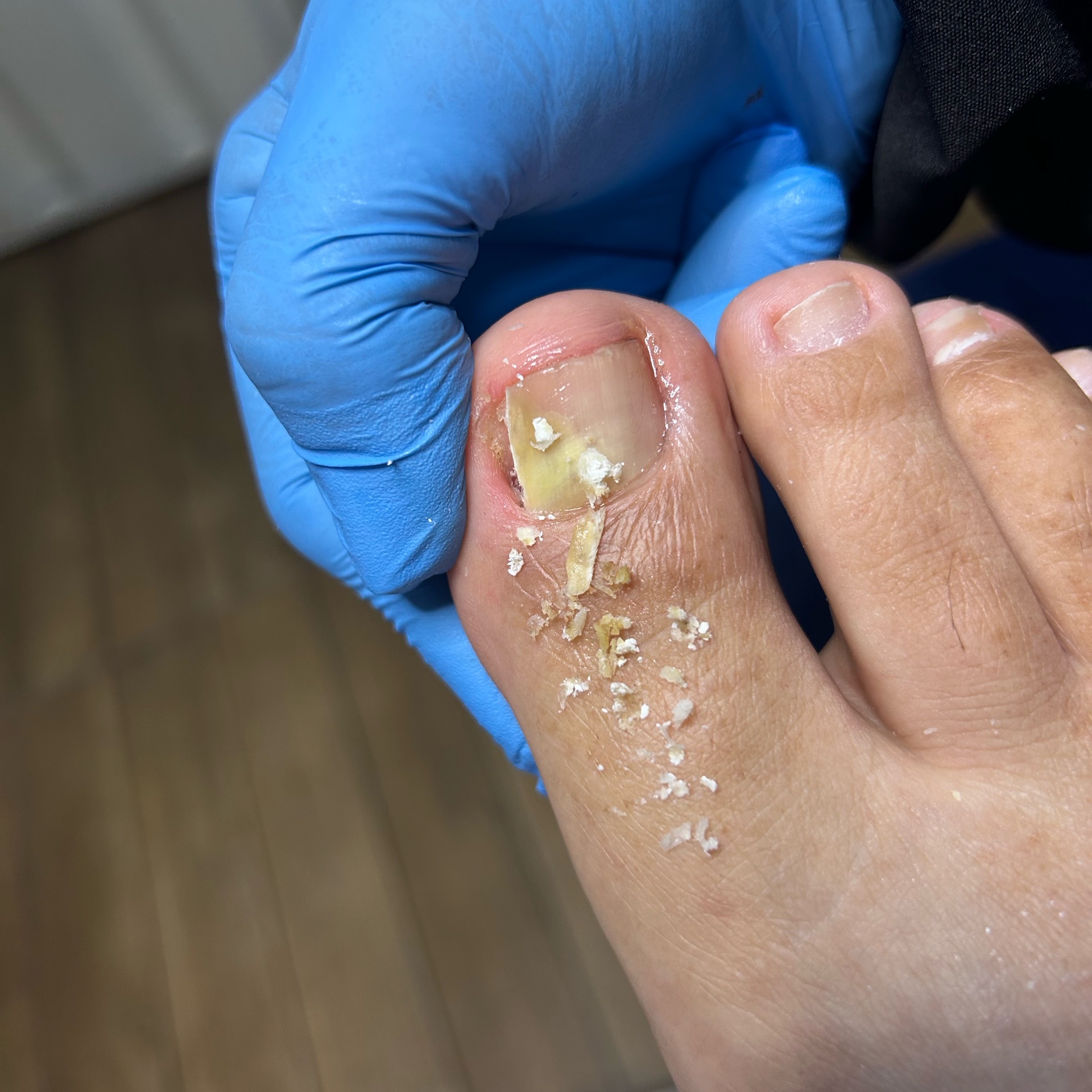ONICOCRIPTOSE desencravar unhas com anestésico tópico e LASER