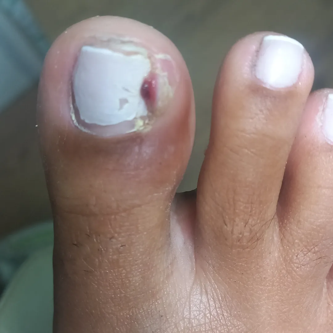 Granuloma (carne esponjosa)